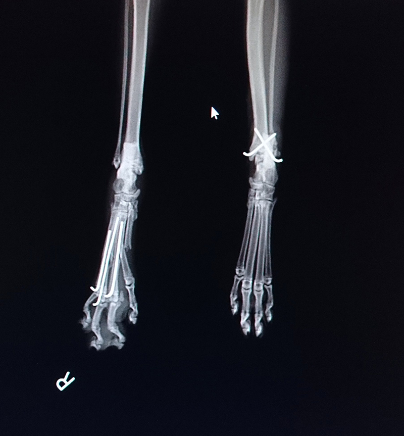 中足骨骨折4箇所（右側）遠位脛骨骨端板骨折（左側）